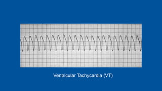 Ventricular Tachycardia (VT)
 
