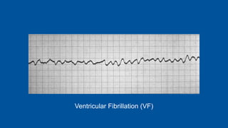 Ventricular Fibrillation (VF)
 