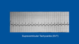 Supraventricular Tachycardia (SVT)
 