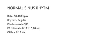 NORMAL SINUS RHYTM
Rate- 60-100 bpm
Rhythm- Regular
P before each QRS
PR interval = 0.12 to 0.20 sec
QRS= < 0.12 sec
 