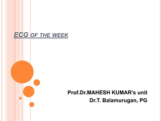 ECG of the week Prof.Dr.MAHESH KUMAR’s unit Dr.T. Balamurugan, PG 