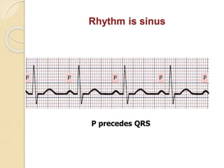 Sinus R1 Comprehensive Introduction to Clinical Electrocardiography and ECG ...