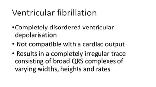 Ventricular fibrillation
•Completely disordered ventricular
depolarisation
• Not compatible with a cardiac output
• Results in a completely irregular trace
consisting of broad QRS complexes of
varying widths, heights and rates
 