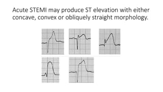 Acute STEMI may produce ST elevation with either
concave, convex or obliquely straight morphology.
 