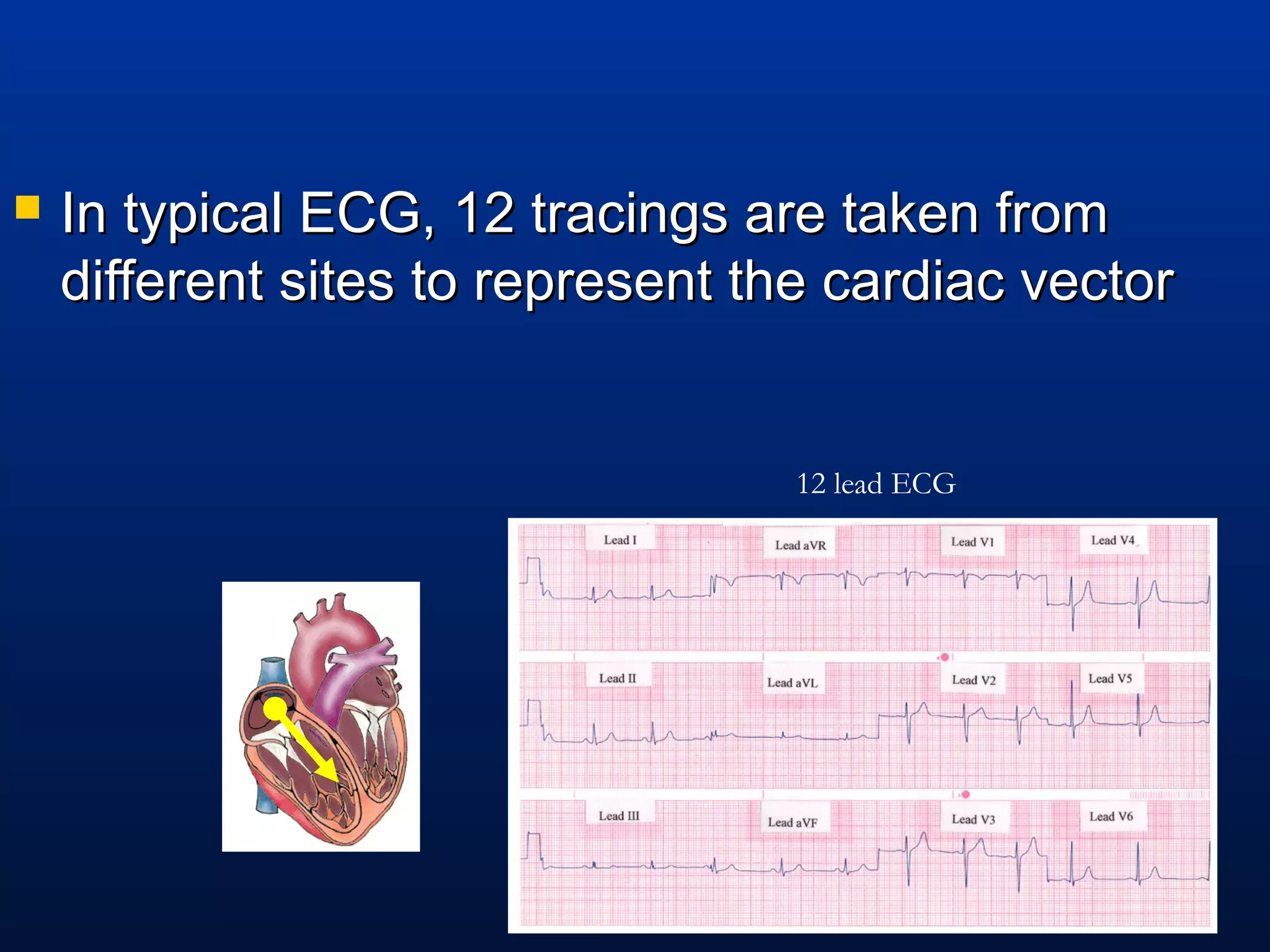  In typical ECG, 12 tracings are taken fromIn typical ECG, 12 tracings are taken from
different sites to represent the cardiac vectordifferent sites to represent the cardiac vector
12 lead ECG
 