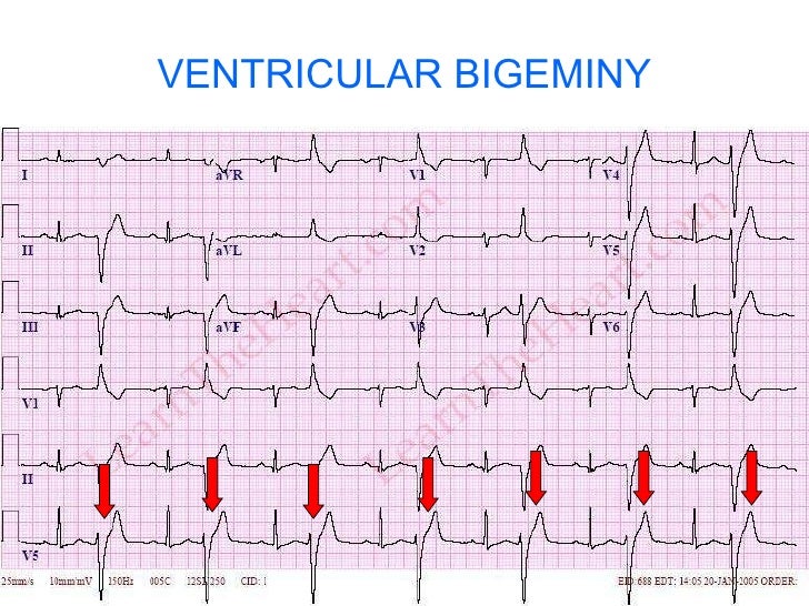 ECG Ventricular Premature Beats