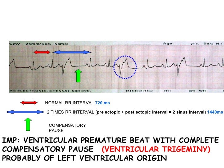 ECG Ventricular Premature Beats