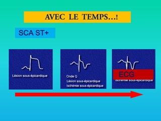 SCA ST+

ECG

 