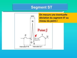On mesure une éventuelle
déviation du segment ST au
niveau du point J

 