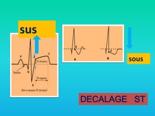sus
J

sous

J

DECALAGE ST

 