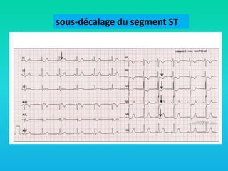 sous-décalage du segment ST

 
