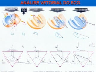 ANÁLISE VETORIAL DO ECG
 