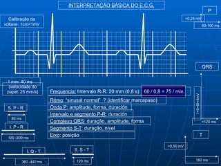 INTERPRETAÇÃO BÁSICA DO E.C.G.
                                                                                                                P
  Calibração da                                                                          <0,25 mV
voltaxe: 1cm=1mV                                                                                             60-100 ms




                                                                                                             QRS


 1 mm: 40 ms
  (velocidade do
 papel: 25 mm/s)         Frequencia: Intervalo R-R: 20 mm (0,8 s) 60 / 0,8 = 75 / min.




                                                                                              I+II+III<4mV
                         Ritmo: “sinusal normal” ? (identificar marcapaso)
 S. P - R                Onda P: amplitude, forma, duración
                         Intervalo e segmento P-R: duración
   80 ms
                         Complexo QRS: duração, amplitude, forma                                             <120 ms
  I. P - R               Segmento S-T: duração, nivel
                         Eixo: posição                                                                   T
 120 -200 ms

                                                                              <0,50 mV
             I. Q - T               S. S - T

           360 -440 ms               120 ms                                                   160 ms
 
