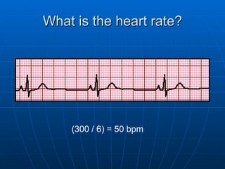 What is the heart rate?




    (300 / 6) = 50 bpm
 