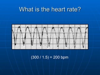 What is the heart rate?




    (300 / 1.5) = 200 bpm
 