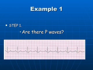 Example 1

   STEP 1.
         • Are there P waves?
 