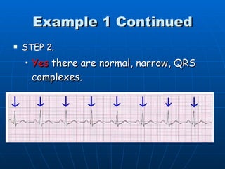 Example 1 Continued
   STEP 2.
    • Yes there are normal, narrow, QRS
      complexes.
 