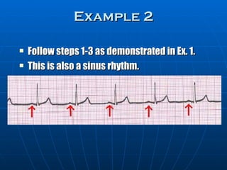 Example 2

   Follow steps 1-3 as demonstrated in Ex. 1.
   This is also a sinus rhythm.
 