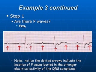 Example 3 continued
   Step 1
    • Are there P waves?
          Yes,




    • Note: notice the dotted arrows indicate the
      location of P waves buried in the stronger
      electrical activity of the QRS complexes.
 