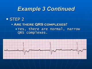 Example 3 Continued
   STEP 2
    • Are there QRS complexes?
        Yes, there are normal, narrow
         QRS complexes.
 