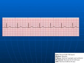 Ecg 3.0