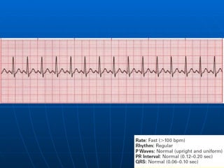 Ecg 3.0