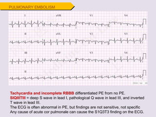 PULMONARY EMBOLISM
Tachycardia and incomplete RBBB differentiated PE from no PE.
SIQIIITIII = deep S wave in lead I, pathological Q wave in lead III, and inverted
T wave in lead III.
The ECG is often abnormal in PE, but findings are not sensitive, not specific
Any cause of acute cor pulmonale can cause the S1Q3T3 finding on the ECG.
 