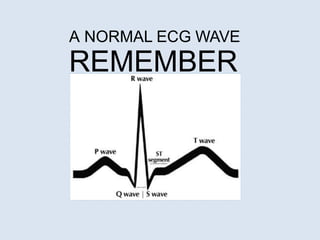 A NORMAL ECG WAVE
REMEMBER
 