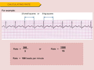300
CALCULATING RATE
For example:
Rate =
3
1500
15
Rate =
or
Rate = 100 beats per minute
 