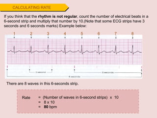 CALCULATING RATE
If you think that the rhythm is not regular, count the number of electrical beats in a
6-second strip and multiply that number by 10.(Note that some ECG strips have 3
seconds and 6 seconds marks) Example below:
1 2 3 4 5 6 7 8
= (Number of waves in 6-second strips) x 10
= 8 x 10
= 80 bpm
Rate
There are 8 waves in this 6-seconds strip.
 