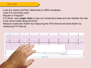 RHYTHM
Look at p waves and their relationship to QRS complexes.
Lead II is commonly used
Regular or irregular?
If in doubt, use a paper strip to map out consecutive beats and see whether the rate
is the same further along the ECG.
Measure ventricular rhythm by measuring the R-R interval and atrial rhythm by
measuring P-P interval.
 