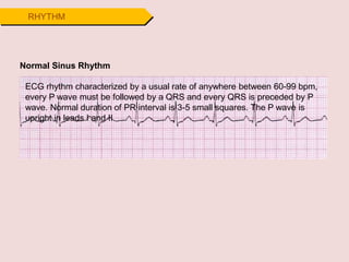 RHYTHM
Normal Sinus Rhythm
ECG rhythm characterized by a usual rate of anywhere between 60-99 bpm,
every P wave must be followed by a QRS and every QRS is preceded by P
wave. Normal duration of PR interval is 3-5 small squares. The P wave is
upright in leads I and II
 