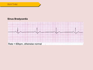 Sinus Bradycardia
Rate < 60bpm, otherwise normal
RHYTHM
 