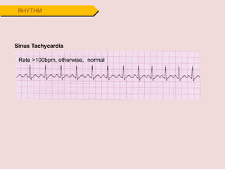 RHYTHM
Sinus Tachycardia
Rate >100bpm, otherwise, normal
 