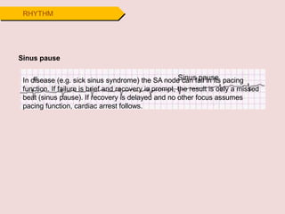 RHYTHM
Sinus pause
In disease (e.g. sick sinus syndrome) the SA node can fail in its pacing
function. If failure is brief and recovery is prompt, the result is only a missed
beat (sinus pause). If recovery is delayed and no other focus assumes
pacing function, cardiac arrest follows.
 