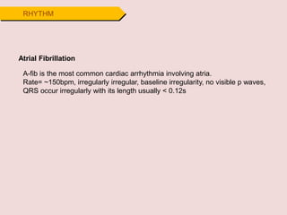 RHYTHM
Atrial Fibrillation
A-fib is the most common cardiac arrhythmia involving atria.
Rate= ~150bpm, irregularly irregular, baseline irregularity, no visible p waves,
QRS occur irregularly with its length usually < 0.12s
 