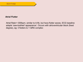 RHYTHM
Atrial Flutter
Atrial Rate=~300bpm, similar to A-fib, but have flutter waves, ECG baseline
adapts ‘saw-toothed’ appearance’. Occurs with atrioventricular block (fixed
degree), eg: 3 flutters to 1 QRS complex:
 
