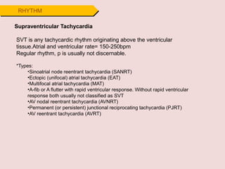 RHYTHM
Supraventricular Tachycardia
SVT is any tachycardic rhythm originating above the ventricular
tissue.Atrial and ventricular rate= 150-250bpm
Regular rhythm, p is usually not discernable.
*Types:
•Sinoatrial node reentrant tachycardia (SANRT)
•Ectopic (unifocal) atrial tachycardia (EAT)
•Multifocal atrial tachycardia (MAT)
•A-fib or A flutter with rapid ventricular response. Without rapid ventricular
response both usually not classified as SVT
•AV nodal reentrant tachycardia (AVNRT)
•Permanent (or persistent) junctional reciprocating tachycardia (PJRT)
•AV reentrant tachycardia (AVRT)
 