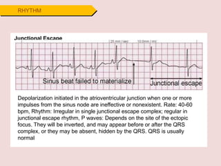RHYTHM
Junctional Escape
Depolarization initiated in the atrioventricular junction when one or more
impulses from the sinus node are ineffective or nonexistent. Rate: 40-60
bpm, Rhythm: Irregular in single junctional escape complex; regular in
junctional escape rhythm, P waves: Depends on the site of the ectopic
focus. They will be inverted, and may appear before or after the QRS
complex, or they may be absent, hidden by the QRS. QRS is usually
normal
 