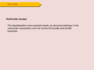 RHYTHM
Ventricular escape
The depolarization wave spreads slowly via abnormal pathway in the
ventricular myocardium and not via the His bundle and bundle
branches.
 