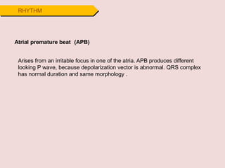 RHYTHM
Atrial premature beat (APB)
Arises from an irritable focus in one of the atria. APB produces different
looking P wave, because depolarization vector is abnormal. QRS complex
has normal duration and same morphology .
 