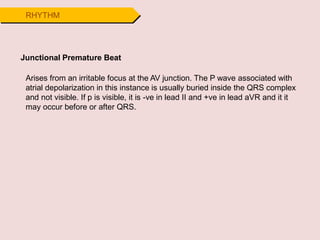 RHYTHM
Junctional Premature Beat
Arises from an irritable focus at the AV junction. The P wave associated with
atrial depolarization in this instance is usually buried inside the QRS complex
and not visible. If p is visible, it is -ve in lead II and +ve in lead aVR and it it
may occur before or after QRS.
 
