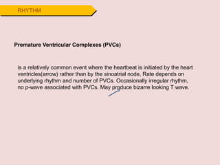 RHYTHM
Premature Ventricular Complexes (PVCs)
is a relatively common event where the heartbeat is initiated by the heart
ventricles(arrow) rather than by the sinoatrial node, Rate depends on
underlying rhythm and number of PVCs. Occasionally irregular rhythm,
no p-wave associated with PVCs. May produce bizarre looking T wave.
 