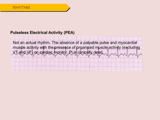 RHYTHM
Pulseless Electrical Activity (PEA)
Not an actual rhythm. The absence of a palpable pulse and myocardial
muscle activity with the presence of organized muscle activity (excluding
VT and VF) on cardiac monitor. Pt is clinically dead.
 