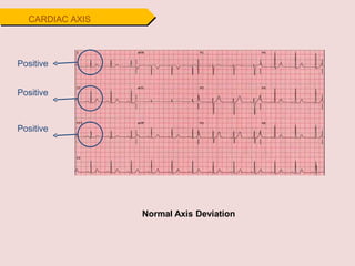 Positive
Positive
Positive
Normal Axis Deviation
CARDIAC AXIS
 