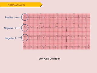 Positive
Negative
Negative
Left Axis Deviation
CARDIAC AXIS
 