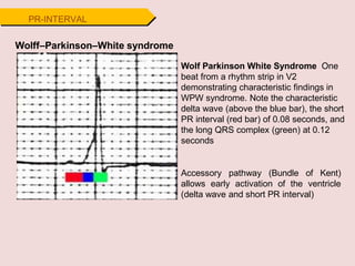 PR-INTERVAL
Wolff–Parkinson–White syndrome
Wolf Parkinson White Syndrome One
beat from a rhythm strip in V2
demonstrating characteristic findings in
WPW syndrome. Note the characteristic
delta wave (above the blue bar), the short
PR interval (red bar) of 0.08 seconds, and
the long QRS complex (green) at 0.12
seconds
Accessory pathway (Bundle of Kent)
allows early activation of the ventricle
(delta wave and short PR interval)
 