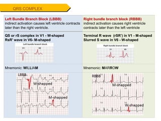 QRS COMPLEX
Left Bundle Branch Block (LBBB)
indirect activation causes left ventricle contracts
later than the right ventricle.
QS or rS complex in V1 - W-shaped
RsR' wave in V6- M-shaped
Right bundle branch block (RBBB)
indirect activation causes right ventricle
contracts later than the left ventricle
Terminal R wave (rSR’) in V1 - M-shaped
Slurred S wave in V6 - W-shaped
Mnemonic: WILLIAM Mnemonic: MARROW
 