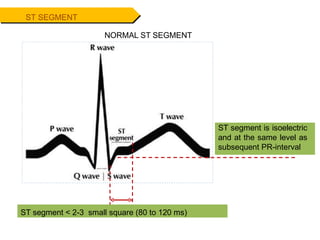 ST SEGMENT
NORMAL ST SEGMENT
ST segment < 2-3 small square (80 to 120 ms)
ST segment is isoelectric
and at the same level as
subsequent PR-interval
 