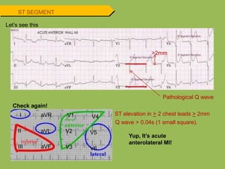 I
II
III
aVR
aVL
aVF
V1
V2
V3
V4
V5
V6
Yup, It’s acute
anterolateral MI!
Pathological Q wave
Check again!
>2mm
ST elevation in > 2 chest leads > 2mm
Q wave > 0.04s (1 small square).
ST SEGMENT
Let’s see this
 